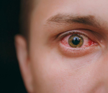 Casos de sífilis ocular aumentam no Brasil