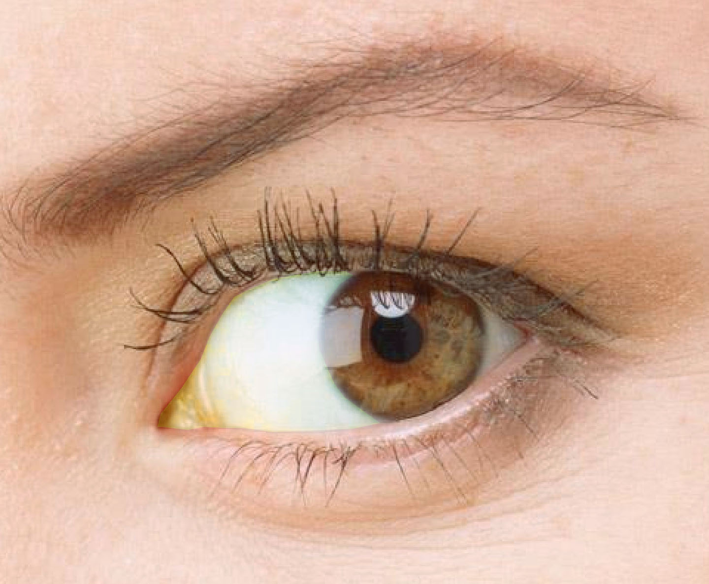 A febre amarela pode afetar os olhos?